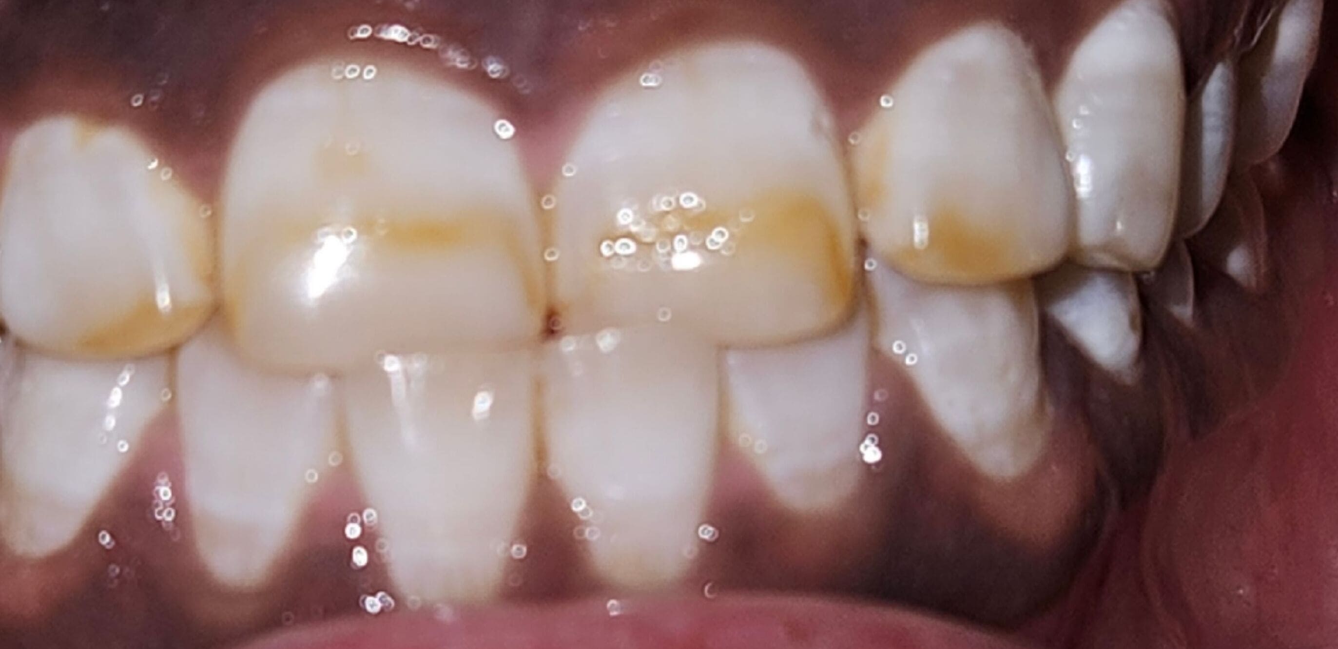 Before Tooth Whitening