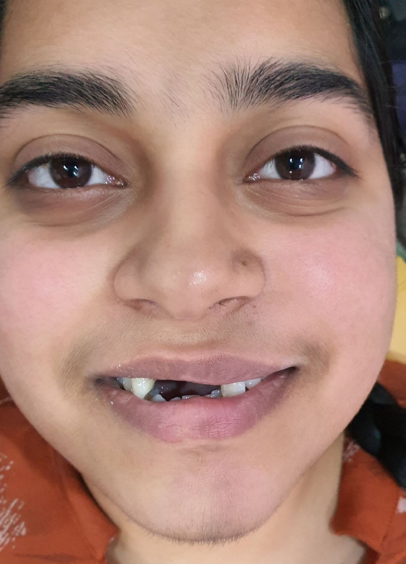 Before Fixed Tooth Treatment