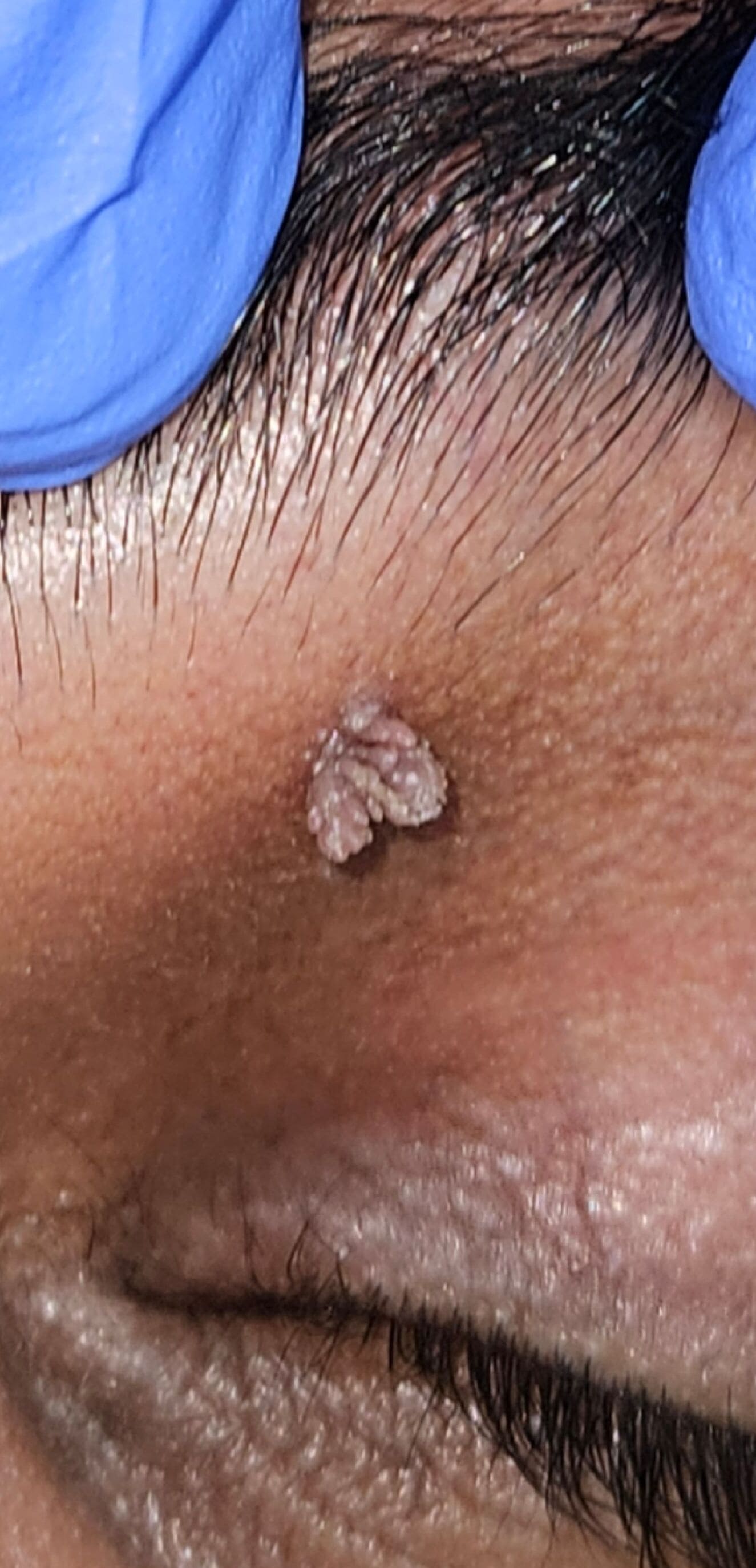 Before Gum Treatment