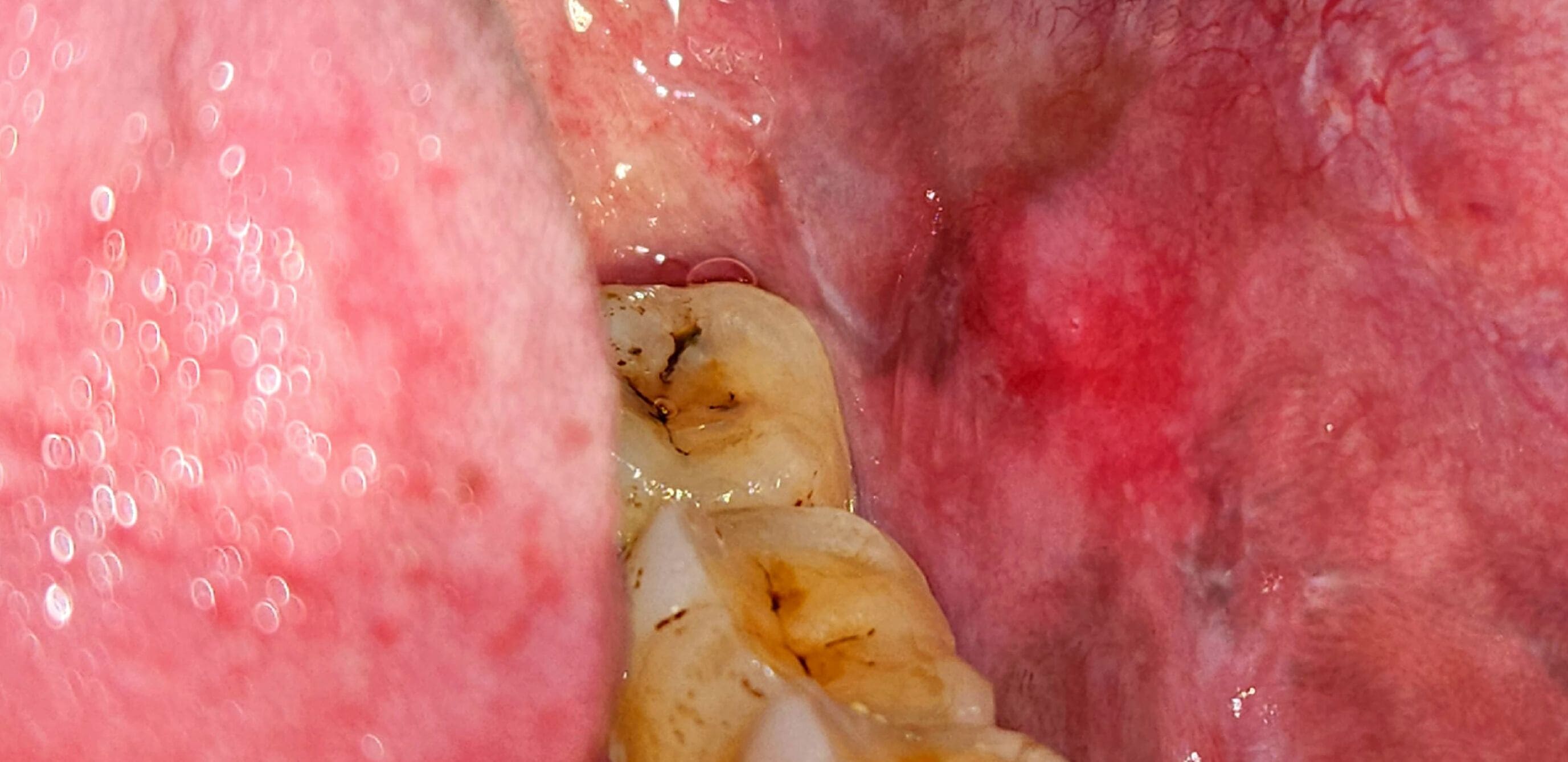 Before Gum Treatment