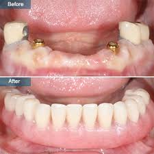 Dental Implant